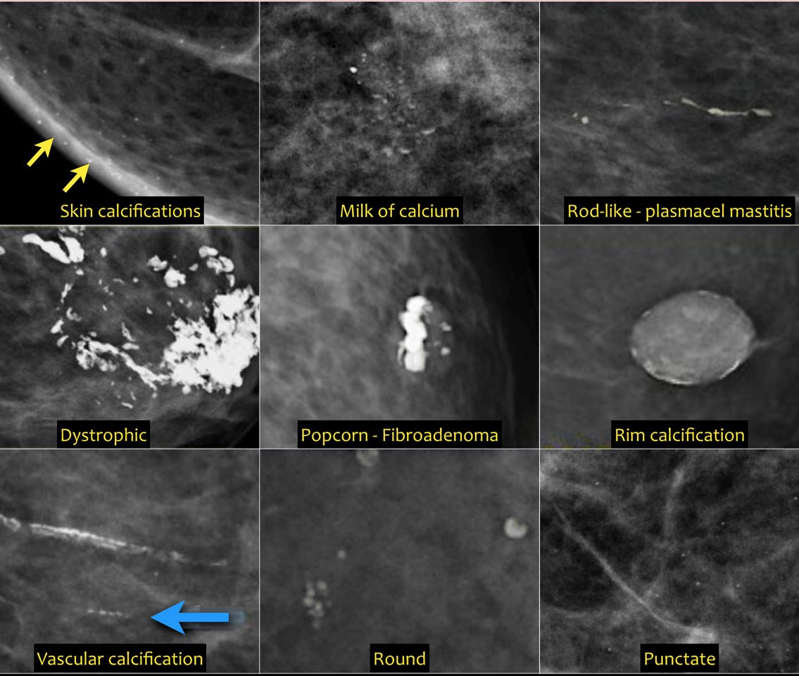 Mammogram - calcifications Information